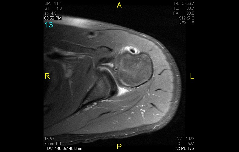 Figure 4 for case anterior shoulder dislocation